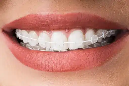 clear braces