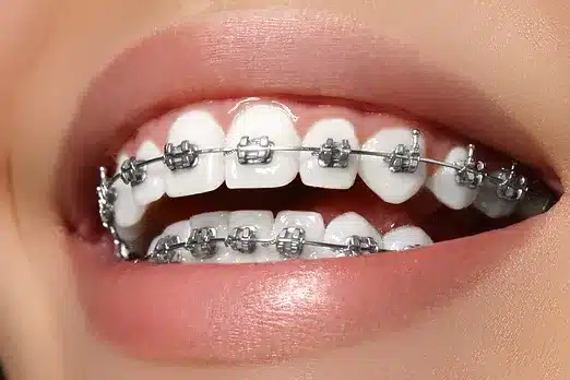 Metal Braces