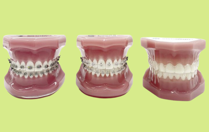 braces, clear braces and Invisalign