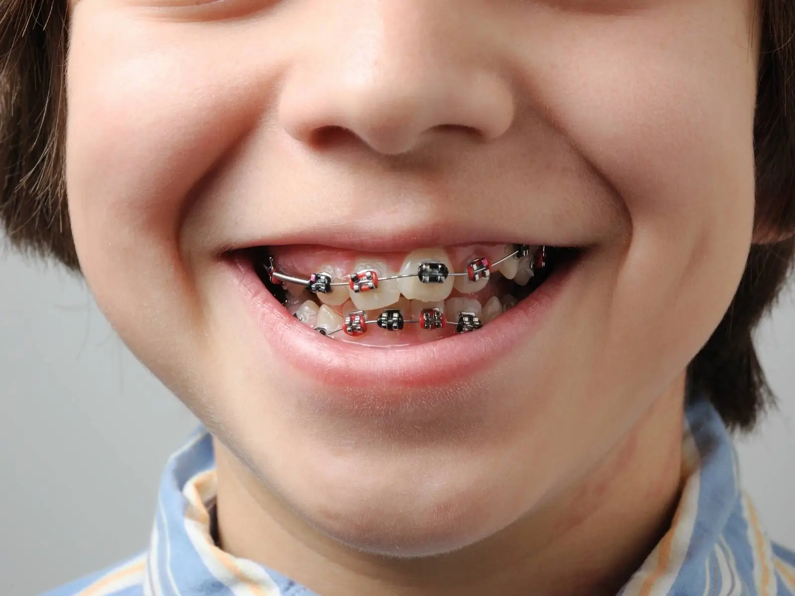 boy smile with braces shows crooked teeth